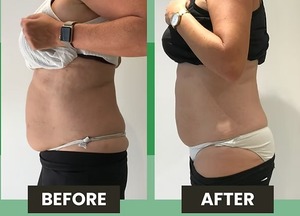 Rodillo de Masaje Portátil para Drenaje Linfático, Relajación Muscular de Espalda, Cuello y Hombros, Máquina para Eliminar la Celulitis - Product Image 6