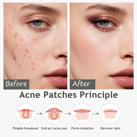 Patchs d'acné hydrocolloïdes en forme d'étoile Infusion d'huile essentielle d'arbre à thé Patchs anti-bactériens pour boutons du visage