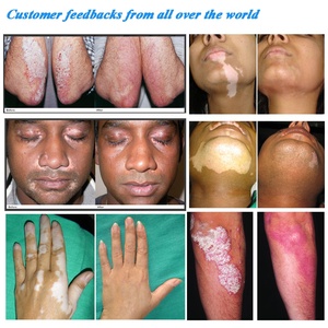 Cabine de photothérapie UVB à bande étroite 311 nm pour le traitement cutané du vitiligo et du psoriasis en dermatologie - Product Image 6