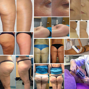 フェイシャルマッサージ減量ローラー痩身美容真空機脂肪除去美容センターボディ痩身と肌の引き締め - Product Image 2