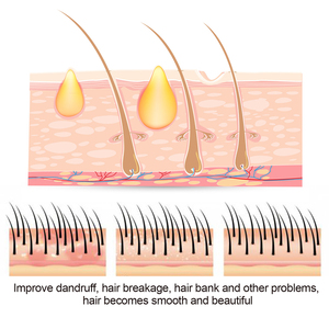 South Moon Sulfur Hair <span class=keywords><strong>Shampooing</strong></span> antipelliculaire rafraîchissant pour soulager les démangeaisons Tinea Capitis réduisant le meilleur <span class=keywords><strong>shampooing</strong></span> séborrhéique pour le cuir chevelu - Product Image 6
