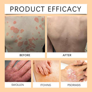 蜂毒最佳快速有效保湿银屑病霜草本湿疹软膏止痒石膏皮肤问题Oem - Product Image 2