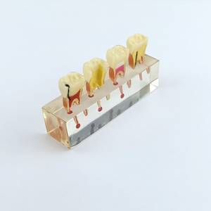 Modello Didattico Dentale Trasparente per Pratica Radicolare, Modello di Denti con Malattie per Studio e Trattamento Endodontico - Product Image 4