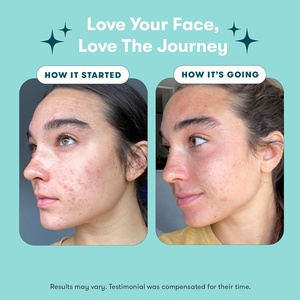 ETRUN ALISA Trattamento Anti-<span class=keywords><strong>Acne</strong></span> in 3 Fasi con Etichetta Privata, Idratante Nutriente Schiarente per il Viso - Vegano e Cruelty-Free, Formato da Viaggio - Product Image 4