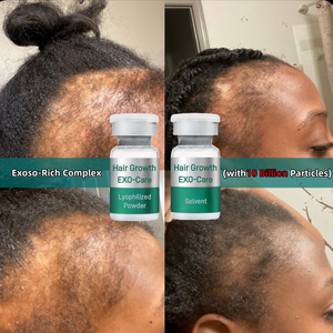 Thérapie <span class=keywords><strong>de</strong></span> repousse des cheveux anti-chute <span class=keywords><strong>de</strong></span> cheveux avancée 10 milliards d'exosomes cellules souches EGF Poudre lyophilisée Solution Elixir <span class=keywords><strong>de</strong></span> croissance des cheveux Accélérateur - Product Image 1