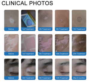 Peninsula Medical Plusieurs tailles de fenêtres 308nm Système laser excimère Vitiligo <span class=keywords><strong>Psoriasis</strong></span> Traitement pour médecin - Product Image 6