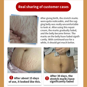 Creme para Remoção de Estrias Pós-parto para Homens e Mulheres, Tratamento Anti-Estrias para Uso em Salão - Product Image 4