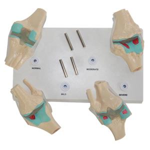 Anatomisch Pvc Kniegewricht Pathologisch Model 4 Stage Artrose Degeneratieve Menselijke Gewrichtsziekte Model - Product Image 5