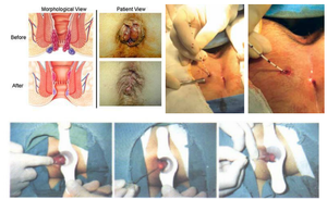 Macchina Chirurgica per Proctologia e Emorroidectomia 1470nm 980nm con Fibra Conica Anorettale per Emorroidi e Fistole Anali - Product Image 5