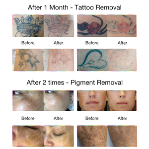 Máquina Profesional de Eliminación de Tatuajes con Láser de Picosegundos PicoKing de 4 Longitudes de Onda - Product Image 6
