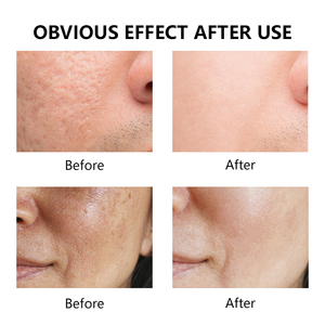 OEM 자체 브랜드 10% 아젤라익산 페이스 세럼 모공 축소 및 균형 조절 포뮬러 (비타민 E 함유, 홍조 및 고르지 못한 피부톤 개선) - Product Image 4