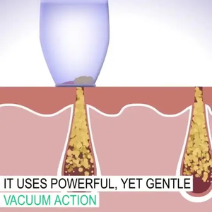 Lỗ chân lông thu hẹp mụn đầu đen Remover chân không lỗ chân lông sạch hơn công cụ mụn đầu đen Remover chân không khuôn mặt vẻ đẹp máy thiết bị công cụ - Product Image 4