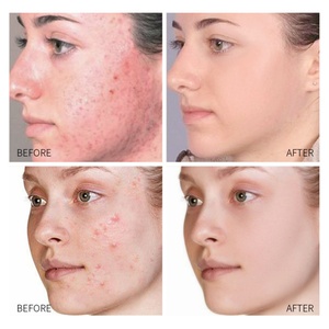 LAIKOU 20g Gel anti-acné à l'aloe vera pour le soin du visage, contrôle du sébum et élimination des boutons, marque privée - Product Image 6