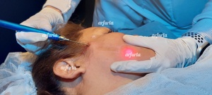 Manípulo de Lipólisis Arfurla, Accesorio Lipo Endoláser para Láser de Diodo de 980nm y 1470nm, 5 Cánulas, CE - Product Image 3