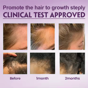 เซรั่มน้ำมันปลูกผมสับปะรดออร์แกนิก30มล. สำหรับผมทุกประเภท - Product Image 5