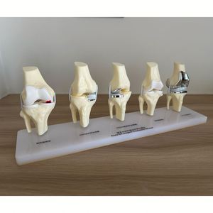 Kyrenmed รูปแบบการรักษาโรคข้อเข่าเสื่อม, แบบจำลองการรักษาโรคข้อเข่าเสื่อม5ขั้นตอน - Product Image 4