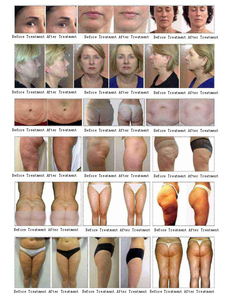 Appareil de massage lymphatique amincissant portable Vela Shape professionnel - Product Image 6