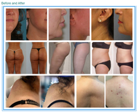 Machine de liposuccion Vaser chirurgicale assistée1470nm Fibres optiques Lipolyse au laser Chirurgie corporelle Endolaser en plastique Lifting du visage