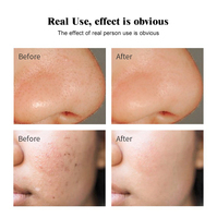 Appareil de beauté à dermabrasion aquatique portable pour usage domestique, nettoyage avec solutions Aqua Peel, élimination de l'acné et des boutons, nettoyage des pores