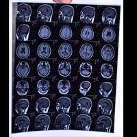 Film Termal Medis Kering 8x10 Inci Biru PET untuk Pencetakan Diagnostik Radiologi Rumah Sakit