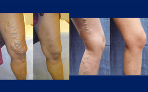 Flebología Endovenosa, Tratamiento Láser para Venas Varicosas, 980nm 1470nm, Eliminación de Venas Varicosas con Láser Mínimamente Invasivo - Product Image 5