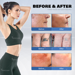 Beauty Salon sử dụng Nd Yag laser Loại bỏ hình xăm thiết bị xách tay Q Switched 4 sóng loại bỏ vết sẹo picosecond Laser Giá máy - Product Image 5