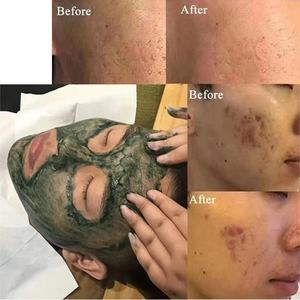 R oem/odm ไม่รุกราน Bio MICR ลอกผิวสำหรับการซ่อมแซมรอยแผลเป็นจากสิวปรับปรุงฝ้าและจุดด่างดำไบโอสาหร่ายลอก spongilla Ule - Product Image 2