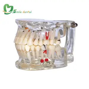 Pathology teeth model dental study model