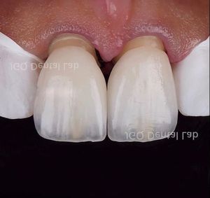 Lapisan porselen yang sangat indah dibuat dengan pengecoran dengan kekuatan tinggi dan terlihat alami dari China <span class=keywords><strong>Dental</strong></span> Lab - Product Image 4