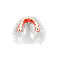 YOUYA DENTAL Nuevo Modelo de Implante Dental de Resina MX-089, 4 Implantes, Mandíbula Baja, Puente Maryland, Restauración de Sobredentadura, Tipodonto Educativo