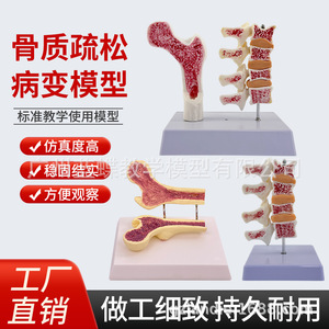 Modèle anatomique d'ostéoporose fémorale humaine, surface anatomique de l'os de la jambe, spécimen de section vertébrale, vertèbre lombaire malade - Product Image 4