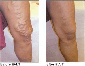 Máquina de ablación láser <span class=keywords><strong>vascular</strong></span> mínimamente invasiva e indolora de 980nm/1470nm, tratamiento láser EVLT para arañas vasculares y varices - Product Image 6