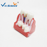 Modèle d'implant dentaire agrandi 4 fois, couronne et pont amovibles pour l'éducation des dentistes et des patients, certifié CE ISO ROHS CNAS