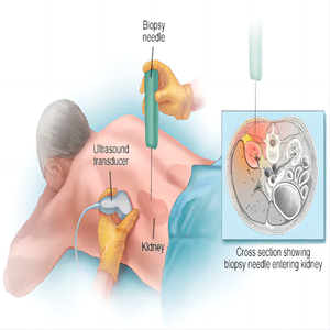Isposable rurucut issue problema uutomático eediopsy Needles - Product Image 4