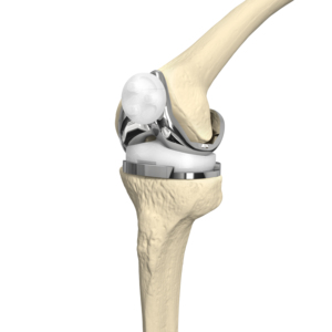 Kit de Reemplazo Total de Rodilla Primario, Implantes Ortopédicos de Aleación CoCrMo, Articulación de Rodilla Artificial para Artroplastia, Certificado CE CANWELL - Product Image 1