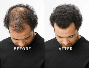 เส้นใยสร้างคอลลาเจนทำจากไลโอฟิลด์พร้อมเดอร์มาเพนสำหรับการเจริญเติบโตของเส้นผมสารละลายป้องกันการหลุดร่วงของเส้นผมจากเส้นผม - Product Image 5