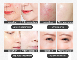 جهاز تنظيف الوجه مع تقنية تنظيف المسام وعلاج التفتيح الضوئي، جهاز مكتبي متعدد الألوان بتقنية الرش البارد النانوية - Product Image 3