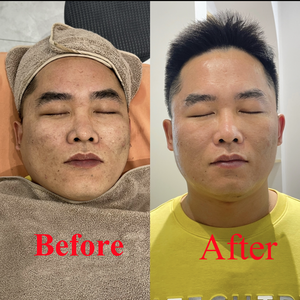 Les taches brunes réduisent les <span class=keywords><strong>vergetures</strong></span> réduisent les spicules de l'éponge Kit de <span class=keywords><strong>traitement</strong></span> de microneedling bio effet évident pour l'utilisation de massage en salon - Product Image 5