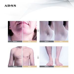 ADSS mesin Laser penghilang rambut, mesin penghilang rambut Android vertikal, sistem operasi 808nm Diode dengan sertifikasi CE - Product Image 3