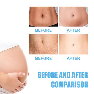 Crema para el Cuidado de las <span class=keywords><strong>Estrías</strong></span> de 100 g a Bajo <span class=keywords><strong>Precio</strong></span>, Crema Reparadora de <span class=keywords><strong>Estrías</strong></span>, Crema Hidratante - Product Image 5