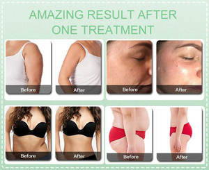 Tueur <span class=keywords><strong>de</strong></span> graisse-forme du corps et système <span class=keywords><strong>de</strong></span> raffermissement <span class=keywords><strong>de</strong></span> la peau réduction <span class=keywords><strong>de</strong></span> la graisse du ventre raffermissant la machine amincissante à rouleaux sous vide pour la peau - Product Image 5