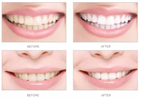 Machine professionnelle de blanchiment des dents, Zoom Laser de luxe, Led, blanchiment, pour clinique dentaire, 2 pièces