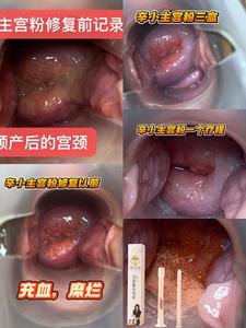 Poudre désinfectante antibactérienne à base de plantes naturelles Sailing pour la réparation de l'érosion cervicale, la réduction de la chaleur et le traitement de l'antivaginite (Yoni Pops) - Product Image 4