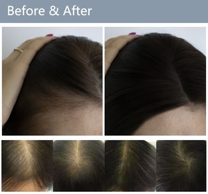 Portable 5-in-1 Scalp Hair Nutrition Care 50x 200x Analyzer Hair Regrowth Multifunctional Head <b>Massage</b> <b>Machine</b> - Product Image 6