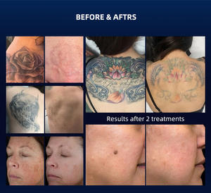 เครื่องเลเซอร์พกพาแบบพิโคเซคันด์ คิวสวิตช์ NdYAG 755 นาโนเมตร สำหรับ<span class=keywords><strong>ลบรอย</strong></span><span class=keywords><strong>สัก</strong></span>และฟื้นฟูผิว - Product Image 6