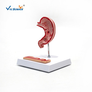 Modèle d'ulcère gastrique, modèle de perforation gastrique, modèle pédagogique de pathologie de l'estomac humain, modèle de coupe transversale gastrique - Product Image 4