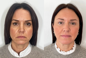 Prix de gros CE BDDE <span class=keywords><strong>Acide</strong></span> <span class=keywords><strong>hyaluronique</strong></span> réticulé injectable pour comblement cutané, anti-rides, amélioration du visage OEM ODM - Product Image 5