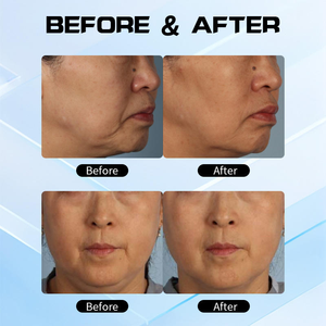 Appareil professionnel de raffermissement cutané et de lifting du visage, double fréquence 6,78 MHz + 2 MHz, machine de contouring du visage pour salon de beauté - Product Image 5