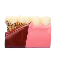 Modèle pathologique dentaire médical modèle anatomique oral dents cariées modèle Dent artificielle