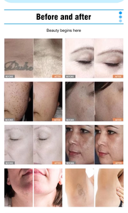 Macchina di Bellezza da Tavolo S.W per Rimozione Pigmenti, Rassodamento della Pelle, Depilazione con 2 Manipoli, Attrezzatura Estetica per Uso Domestico - Product Image 6